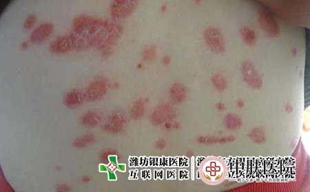 [济南市专科银屑病医院]儿童牛皮癣如何诊断?