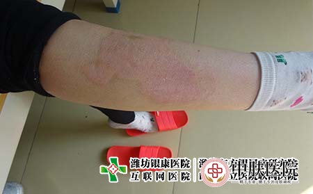 [济南市专科银屑病医院]儿童牛皮癣如何诊断?