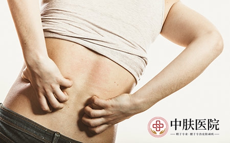 摄图网_304129678_人类抓痒的背皮肤过敏疹健康问题（企业商用）