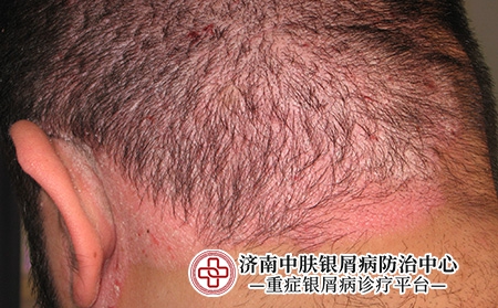 头皮牛皮癣5 头皮牛皮癣5