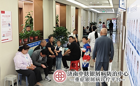 济南关节病型银屑病专家-济南中肤医院