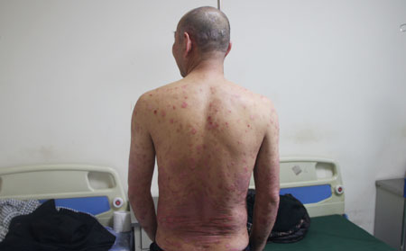 治疗男性银屑病医院