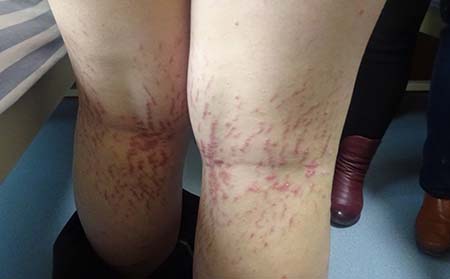 男性银屑病治疗,怎样治男性银屑病